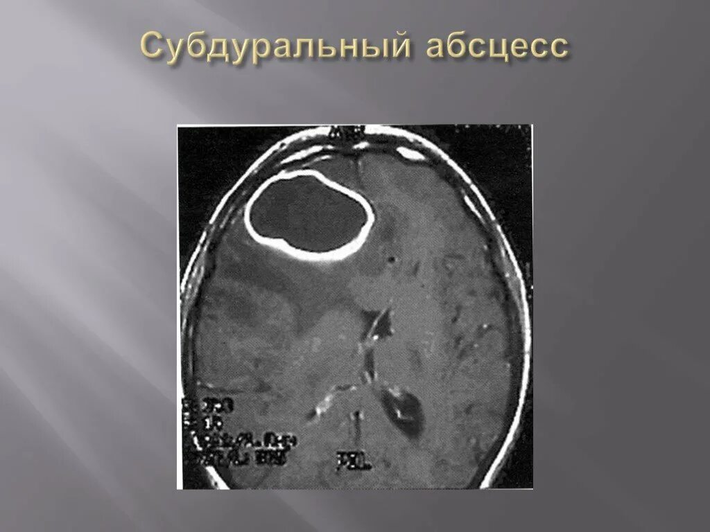 Абсцесс мозга. Экстрадуральный абсцесс кт. Риногенный субдуральный абсцесс. Субдуральный абсцесс кт. Экстра субдуральный абсцесс мозга.