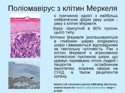 Тест карцинома меркеля по утвержденным клиническим рекомендациям