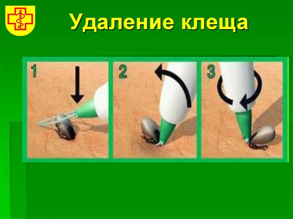 Как вытащить клеща с помощью шприца. Приспособление для удаления клещей. удалить клеща с помощью шприца. вакуумный удалитель клещей.
