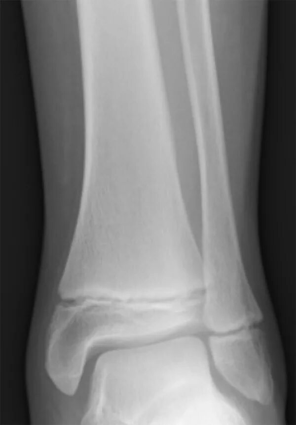 Остеома коленного сустава рентген. Остеома малой берцовой кости. Рентген большеберцовой кости. Остеома большеберцовой кости.