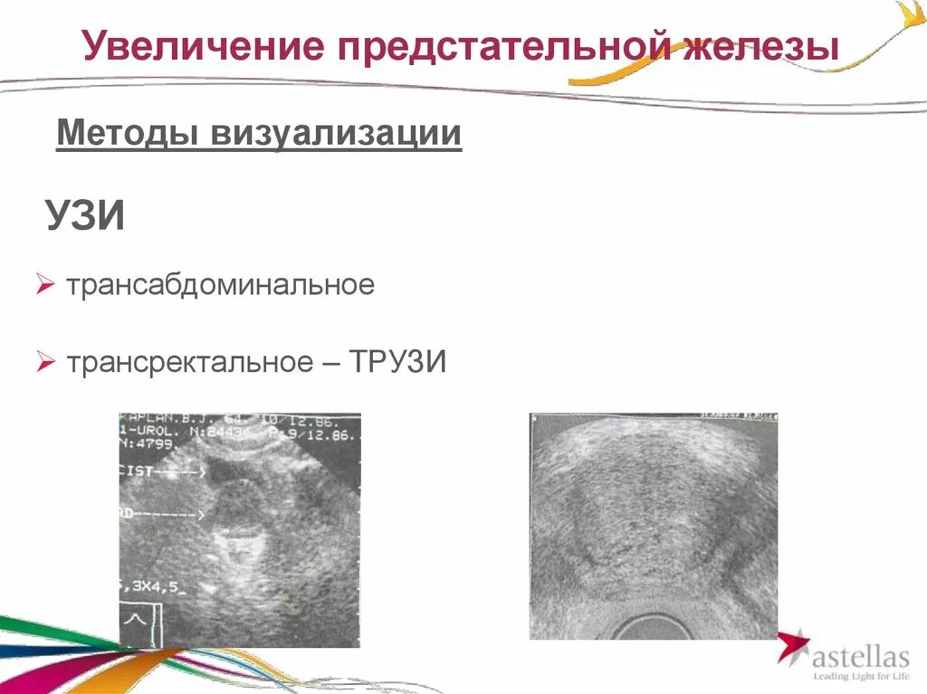 Трансабдоминальное УЗИ предстательной железы. УЗИ предстательной железы трансабдоминально. Датчик для УЗИ предстательной железы. УЗИ мочевого пузыря и предстательной железы (трансабдоминально.