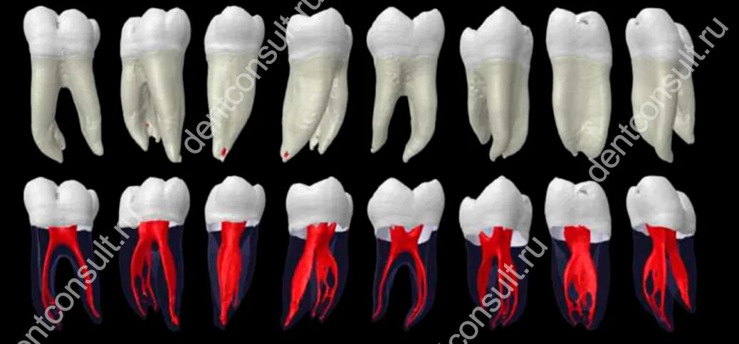 1 корневой канал. Анатомия корневых каналов моляров. Топография корневых каналов 26 зуба. Каналы 46 зуба анатомия корневые. Нижний моляр анатомия корневых каналов.