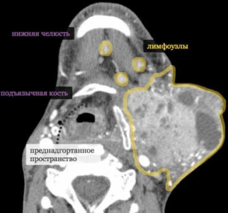 Метастазы рака ротоглотки. Рентгеноанатомия мягких тканей шеи кт. Томограмма гортани рентген. Абсцесс заглоточного пространства на кт. Метастазы рака ротоглотки.