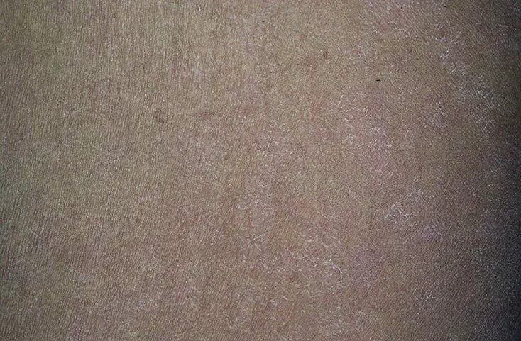Картинки КОВИД КОЖИ
