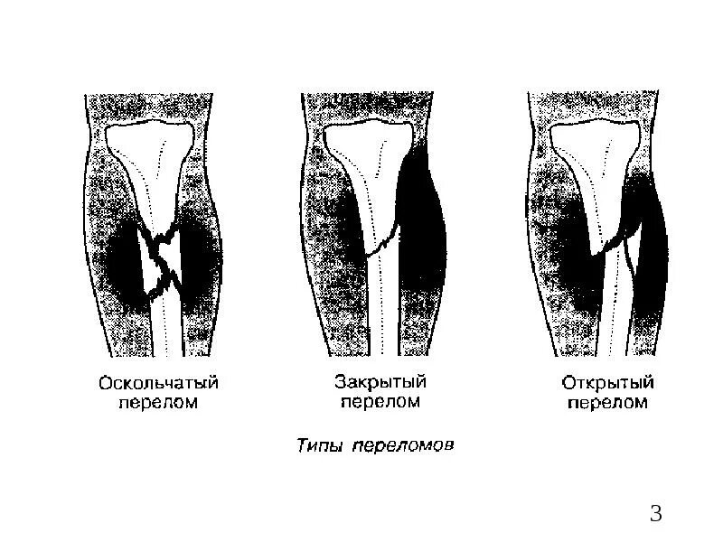 Типы закрытых переломов. Открытый и закрытый перелом. За крыты перелом. Виды переломов открытые закрытые.
