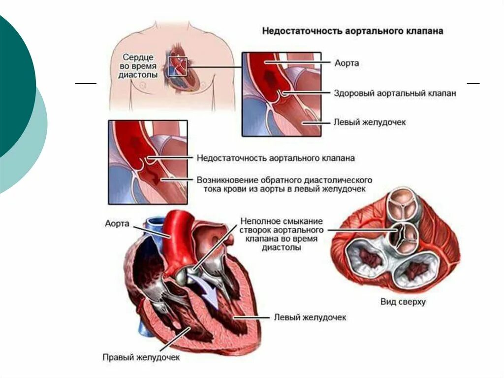 Аортальная клапанная недостаточность. Недостаточность аортального клапана. Проявления недостаточности аортального клапана. Аортальный клапан первой степени. Гемодинамика пациента