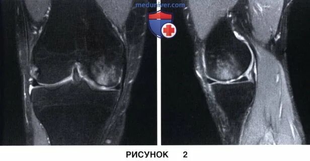Рассекающий остеохондрит надколенника кт. Болезнь кёнига рассекающий остеохондрит мрт. Остеохондральное повреждение мрт. Остеохондральное повреждение мрт. Некроз таранной кости мрт.