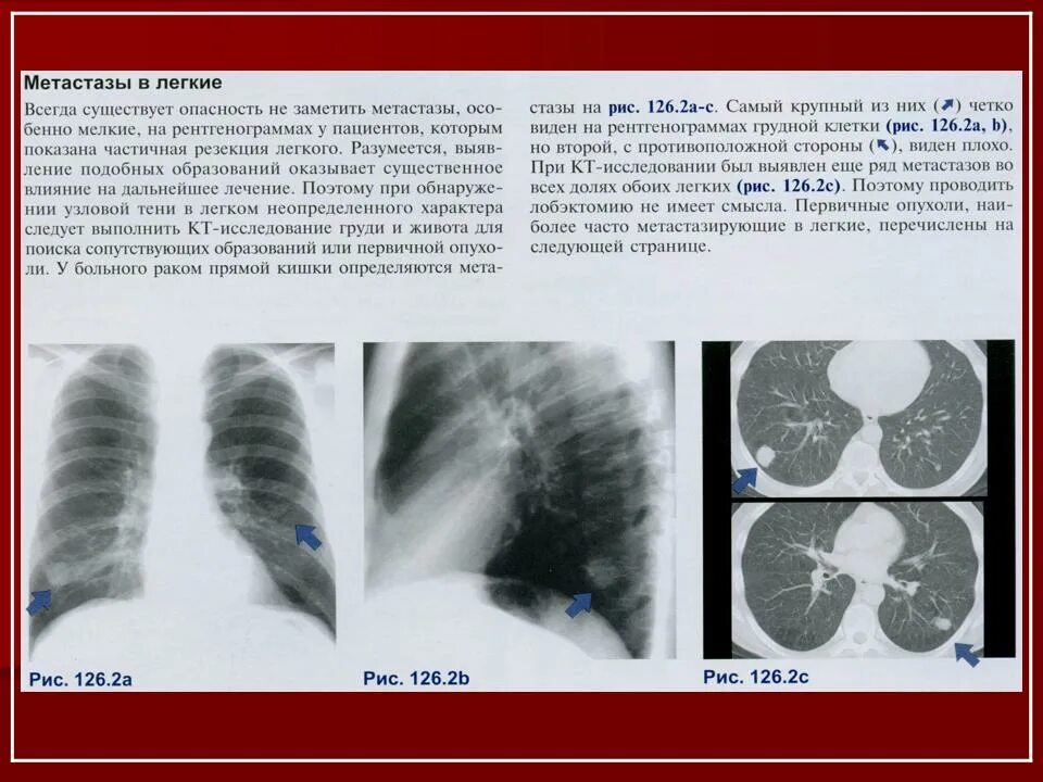 Лучевая диагностика метастатического поражения лёгких. Метастазы в лёгких рентген заключение. Признаки метастаз в легких