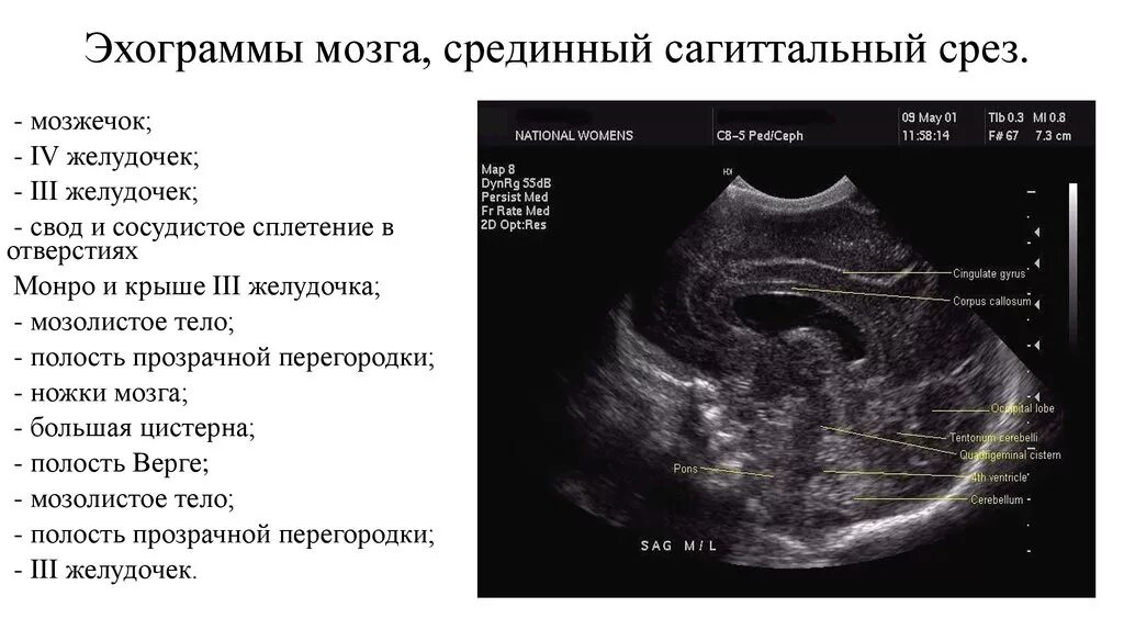 УЗИ головного мозга нейросонография. Боковые желудочки анатомия кт. Сагиттальное сечение НСГ. Ультразвуковая анатомия головного мозга новорожденных. Расширение желудочков у новорожденного