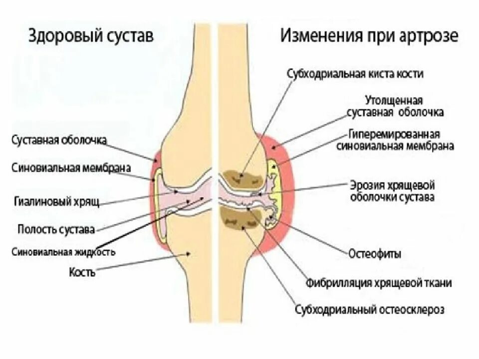 Артрит коленного сустава схема. Изменения суставов при остеоартрозе. Остеоартроз периферических суставов.