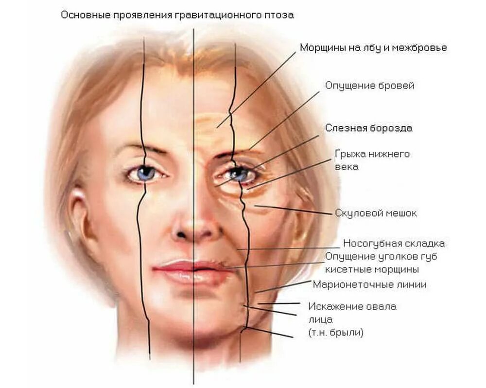 Зона лба. Гравитационный птоз лица. Гравитационный птоз Тип старения. Гравитационный птоз мышцы лица. Птоз возрастной.