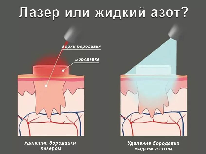 Удаление бородавок лазером ребенку. Подошвенная бородавка азот. выжигание бородавок лазером. удаление бородавок жидким азотом. выжигание бородавок азотом.