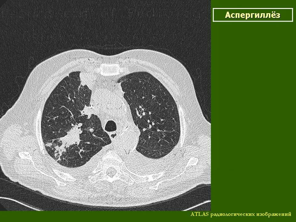 Кт картина. Аспергиллез кт картина. Аспергиллез легких кт картина. Emphysema Soft Tissue CT.
