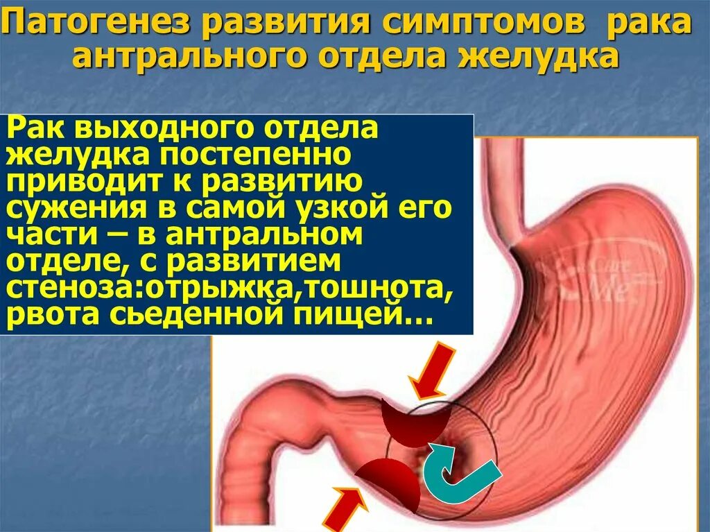 Антациды. Механизм действия - презентация онлайн