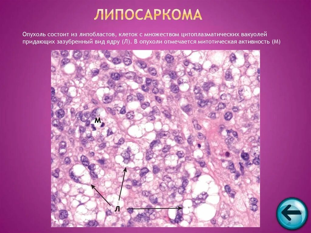 Миксоидная липосаркома гистология. Аденокарцинома, липосаркома. Липосаркома патологическая анатомия. Липосаркома микропрепарат описание. Опухоли и др