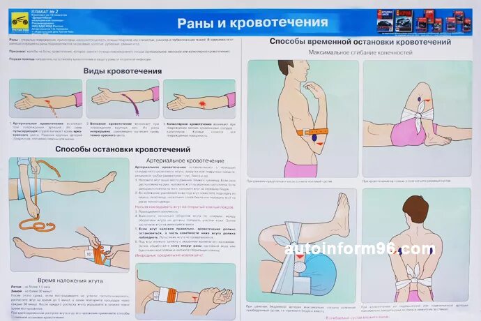 Пути остановки кровотечений. Способы остановки кровотечения. Виды кровотечений способы остановки кровотечений. Способы остановки кровотечения в ране. Способы остановки кровотечения и обработки РАН.