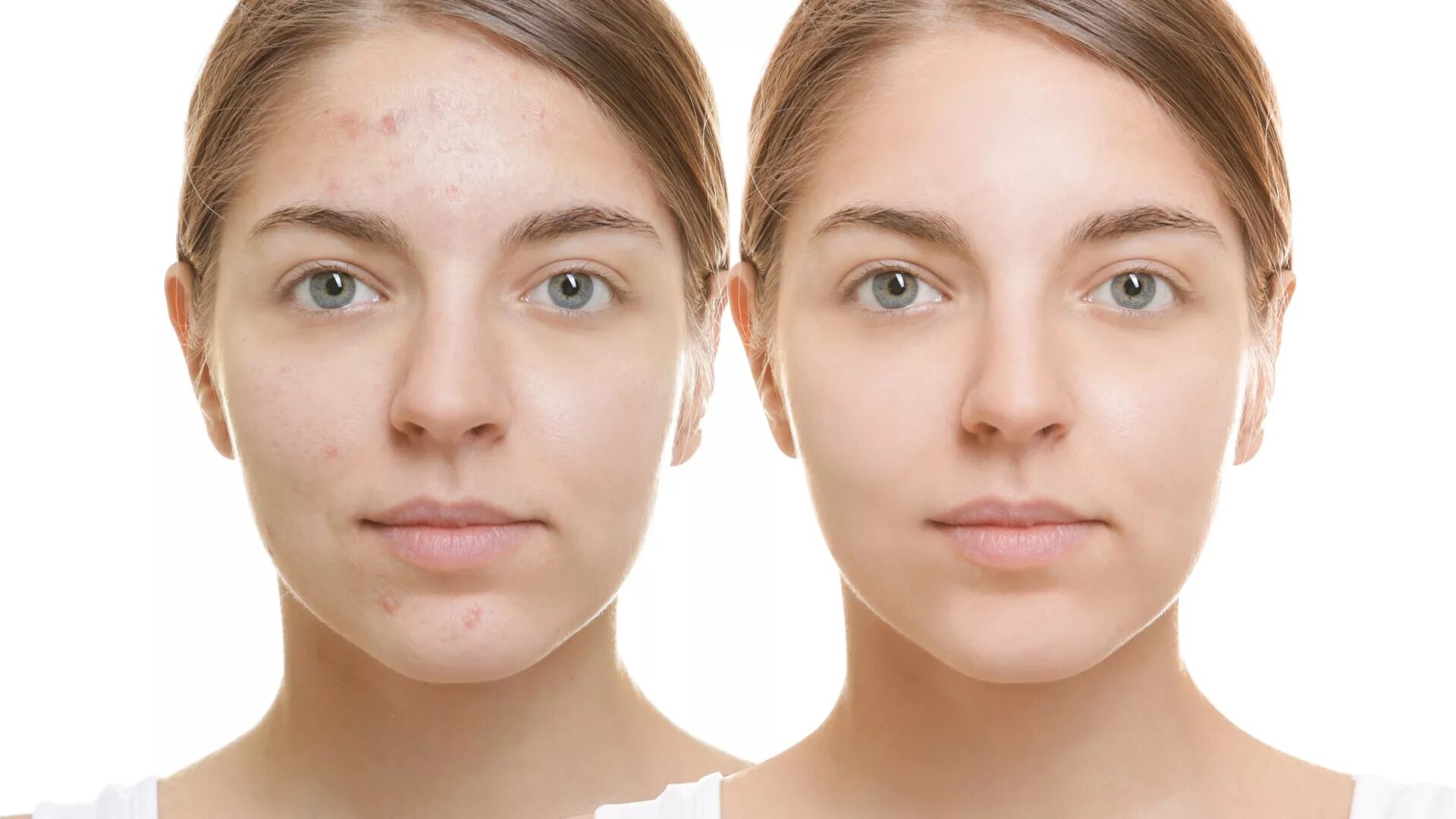 Лицо до после. Интересные лица. Acne program