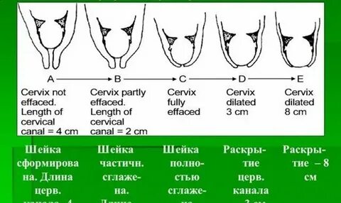 Шейка матки на 6 неделе. Узи шейки матки цервикометрия. Шейка матки в 22 недели беременности норма таблица. Шейка матки на 6 неделе. Шейка матки на 6 неделе.