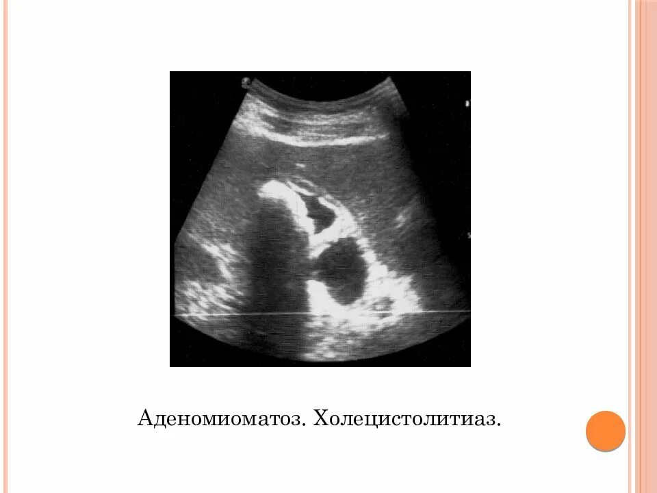 Классификация клиническая желчнокаменной болезни. Аденомиоматоз желчного узи. Классификация осложнений жкб. Холелитиаз и холецистолитиаз. Осложнения желчекаменной болезни.