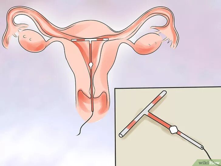 Медьсодержащие внутриматочные контрацептивы (вмк). Спираль мирена внутриматочная. Усики внутриматочной спирали. Вмс kyleena. Внутриматочная спираль методы контрацептивов.