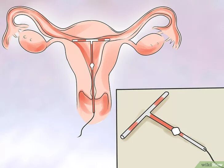 Введение вмс. ВМС внутриматочная спираль. Спираль ВМС Мирена. Внутриматочная спираль метод контрацепции. ВМС Мирена менструационного цикла.