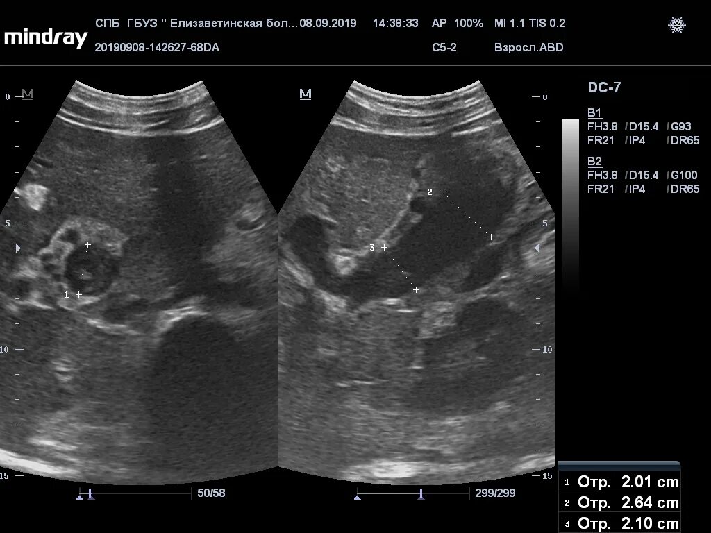 Тромбоз селезеночной вены на УЗИ. Тромбоз воротной вены на УЗИ. Дилатация воротной вены на УЗИ. Тромбоз селезеночной вены на кт. Тромбоз вены печени