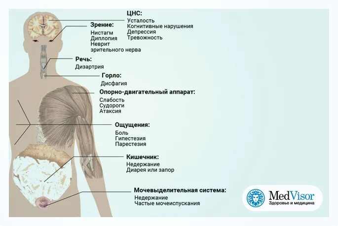 Спастика мышц при рассеянном склерозе. Профилактика при рассеянном склерозе. Эпидемиология рассеянного склероза. Рассеянный склероз ноги. Пациенты с рассеянным склерозом.