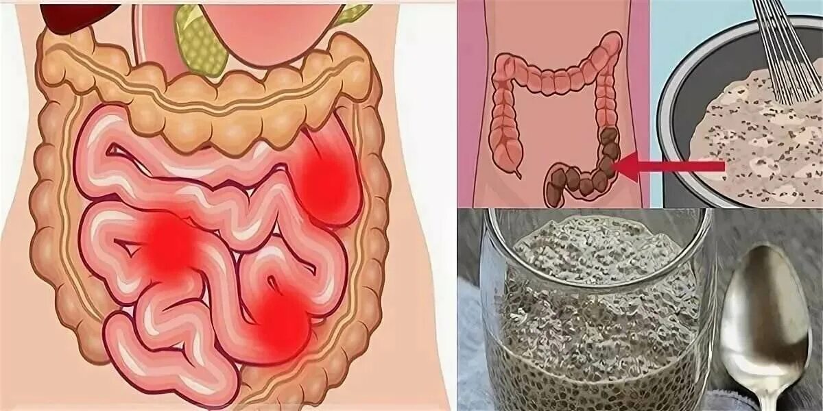 Зашлакованный кишечник. Каловые завалы в кишечнике. После очищения кишечника. Прочистить желудок в домашних