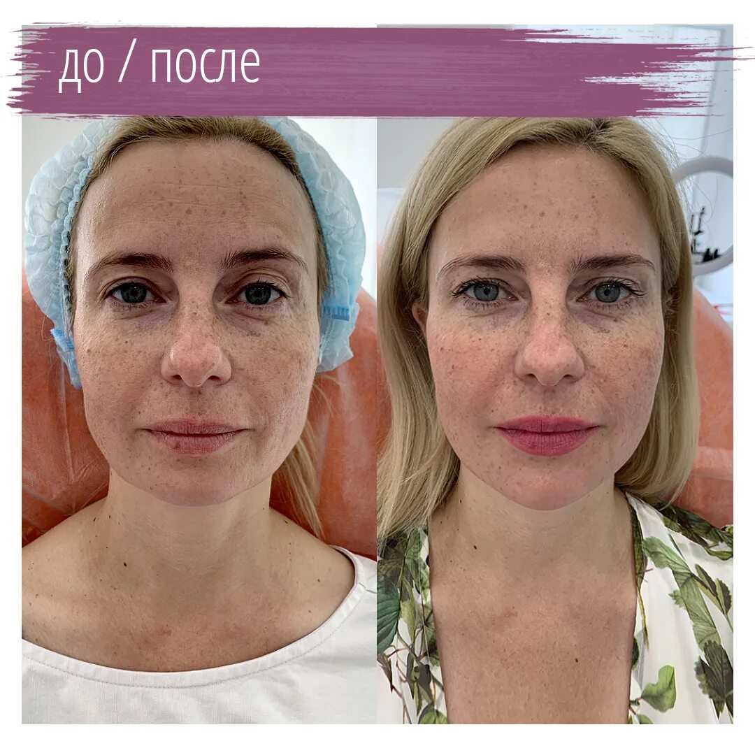 Лицо до и после косметолога. Гармонизация лица до и после. Косметолог омоложение. Ботулинотерапия лица. Процедура для лица после 60