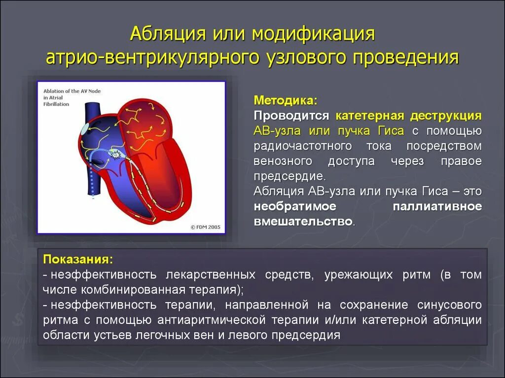 Рча предсердий. Абляция атриовентрикулярного узла. Радиочастотная аблация аритмий сердца. Радиочастотная катетерная абляция. Радио чястотная облация сердца.