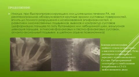 Аксиальный подвывих