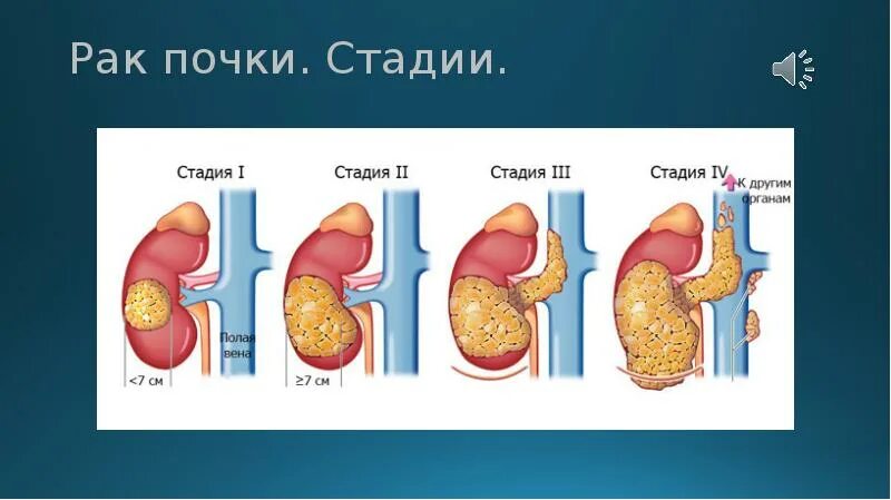 Опухоль почки стадии т1а. Онкология почек стадии. Карцинома почки 2 стадия. 3 стадия рака почки