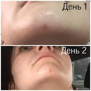 Аллергия снятие отека