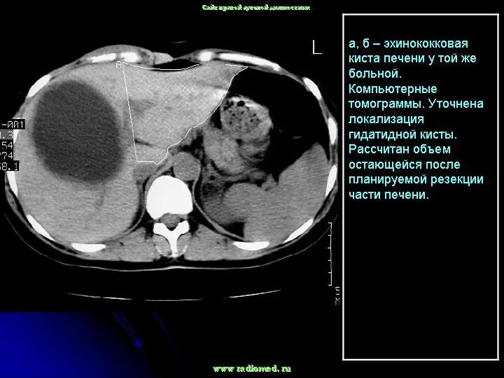 Эхинококковая киста печени кт. Кисты печени кт эхинококкоз. Кт киста печени эхинококковая киста. Эхинококкоз печени мрт. Киста левой печени