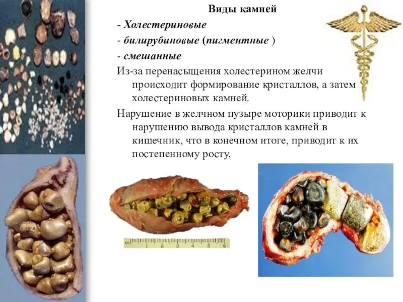 Как узнать камни в желчном. Холестериновые камни в желчном пузыре. холестериновые и билирубиновые камни. холестериновые конкременты жёлчного пузыря.
