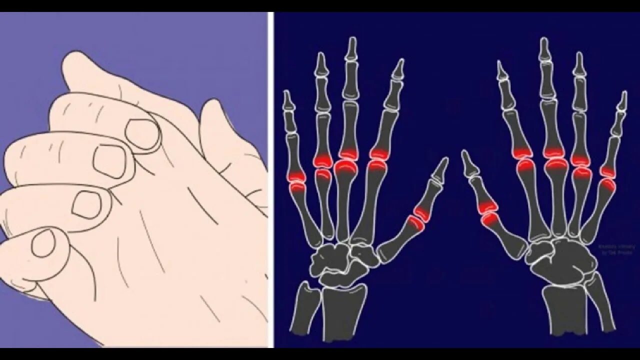 Почему опасная рука. Хрустеть пальцами вредно. Вредная привычка хрустеть пальцами. Щелканье суставами вредная привычка.