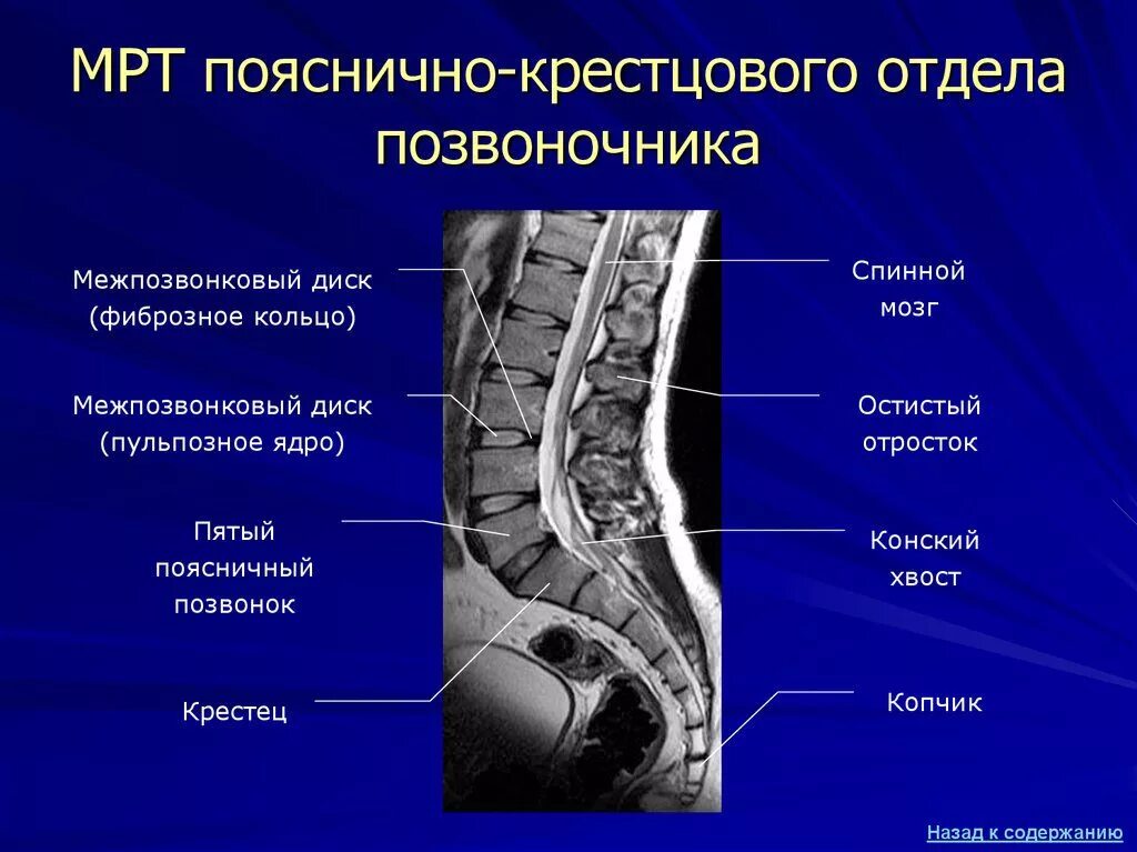 Мрт крестцового отдела позвоночника как подготовиться. Остеохондроз поясничного крестцового отдела на мрт. мрт пояснично-крестцового отдела позвоночника и копчика. мрт пояснично-крестцового отдела позвоночника здорового человека. поясрично крестовый отдел.