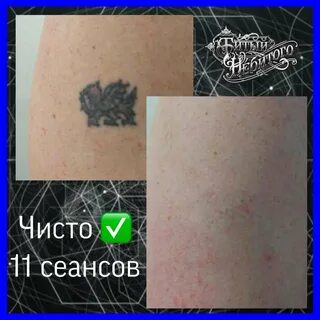 Удаление лазером спб