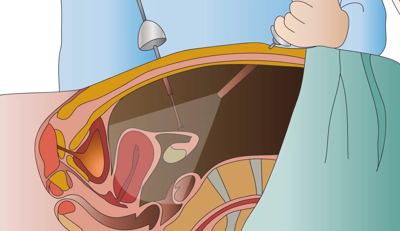 Удаление яичника можно забеременеть после. Лапароскопия эндометриоидной кисты. Цистэктомия яичника лапароскопия. Перекрут кисты яичника лапароскопия. Лапоро лапароскопия кисты яичника.
