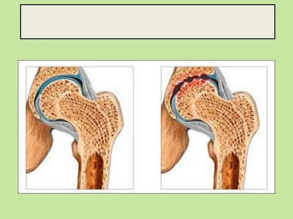 Коксартроз тазобедренного сустава. Артроз тазобедренного сустава. Артроз бедренного сустава.