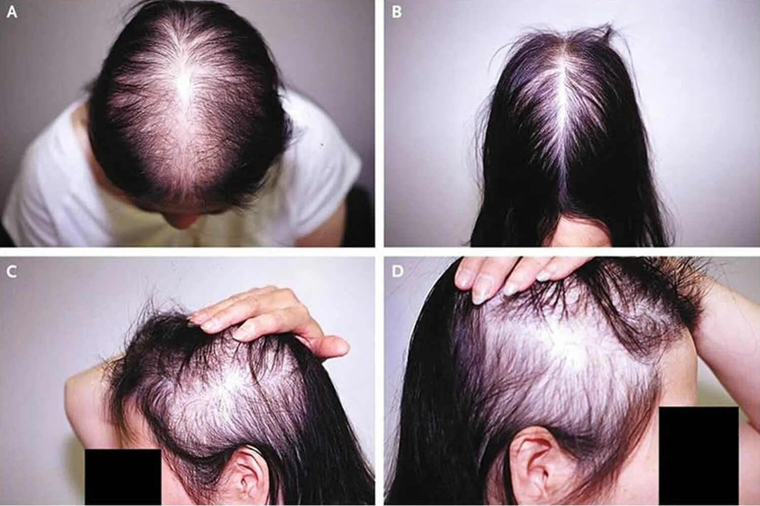 Типы облысения у женщин. Спиронолактон при алопеции у женщин. волосы normal. hair loss обложка.
