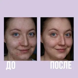 Пилинги до и после реальные фото