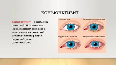 Коньюктивит это