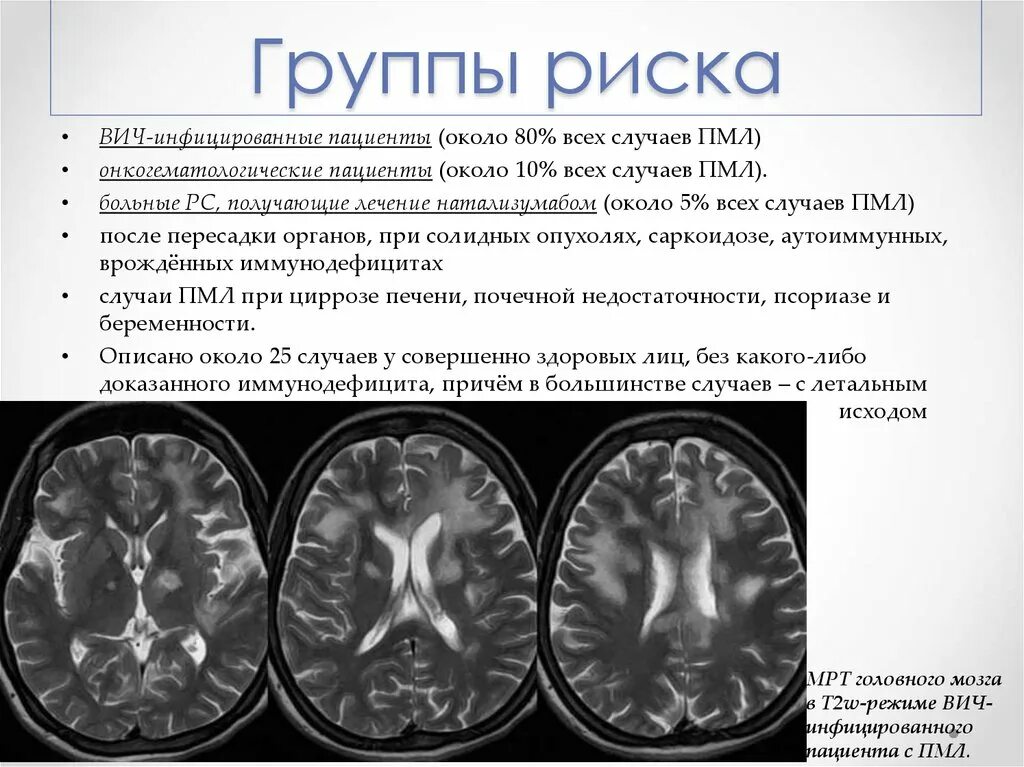 Неспецифические изменения головного мозга. Прогрессирующая мультифокальная лейкоэнцефалопатия (ПМЛ). Прогрессирующая мультифокальная лейкоэнцефалопатия мрт. Лейкоэнцефалопатия головного мозга кт. ПМЛ мрт прогрессирующая мультифокальная лейкоэнцефалопатия.