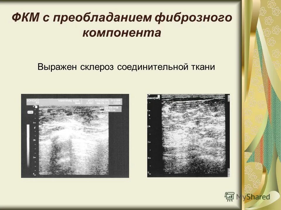 эхографические признаки молочной железы. эхографические признаки молочной железы. фиброзно кистозная мастопатия маммограмма. узловая форма фиброзно-кистозной мастопатии. диффузная мастопатия маммограмма.
