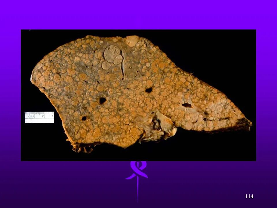 Острый гепатит макропрепарат. Жировая дистрофия печени макропрепарат. Цирроз животных. Цирроз печени у животных. Цирроз животных.