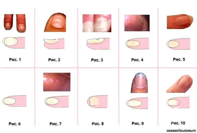 О чем говорит форма ногтей. Типы и формы ногтевых пластин. Формы пластины ногтей. Плоская форма ногтевой пластины. Типы ногтевой пластины.