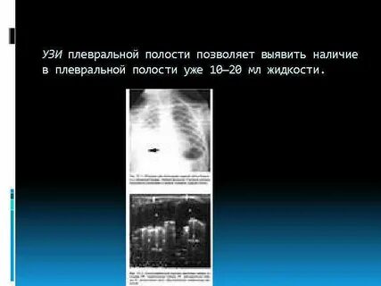 Узи плевральных