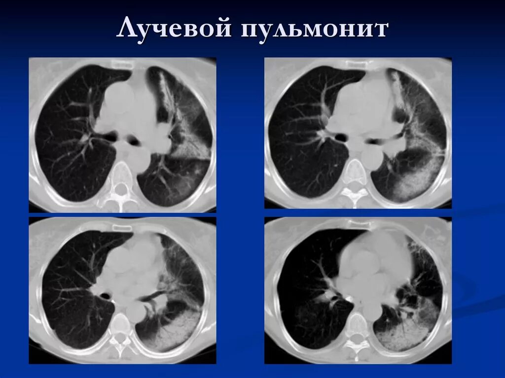 Постлучевой пневмонит на кт. Постлучевой пневмофиброз кт. Пост лучевой пнеамонит.