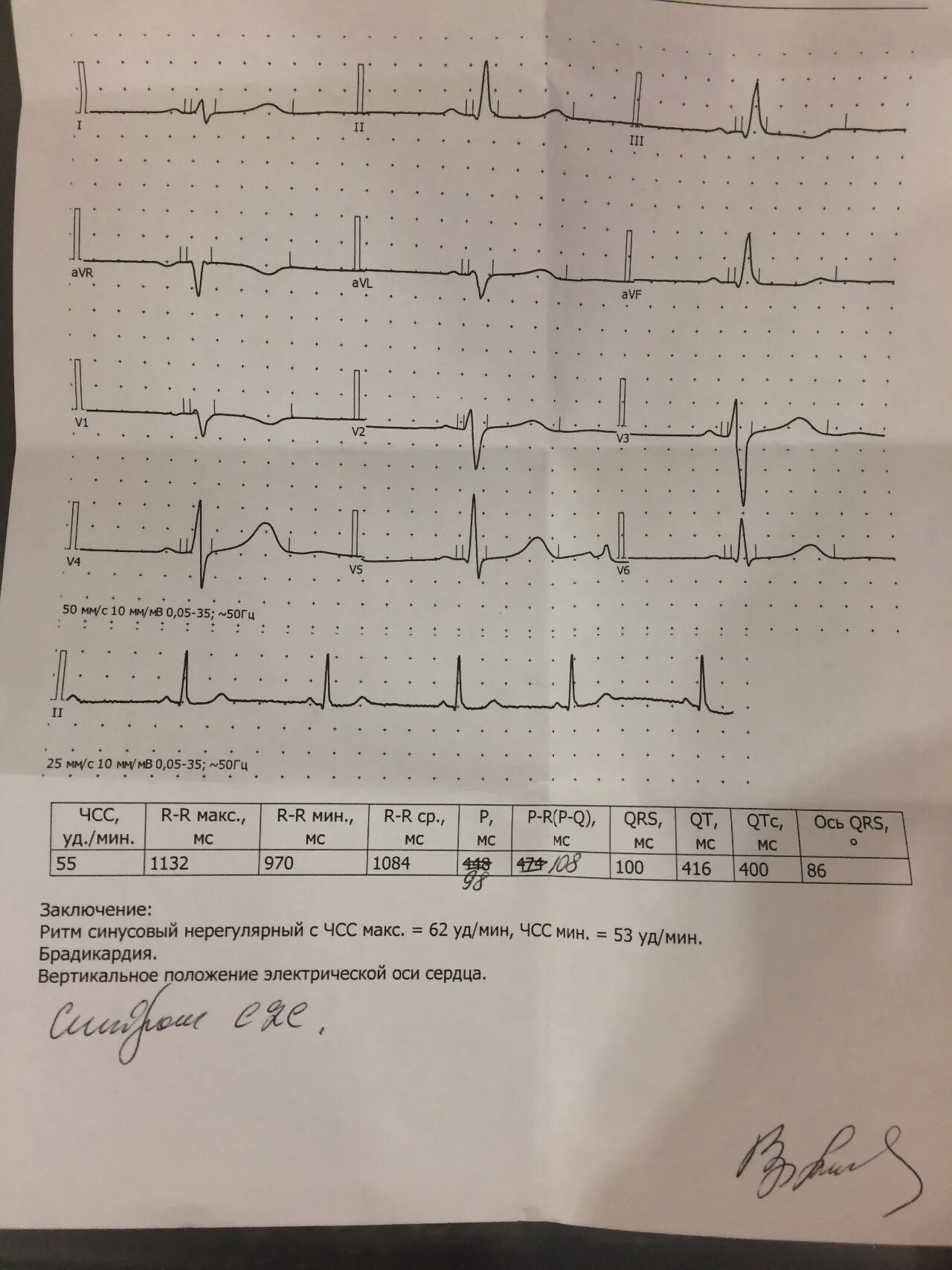 Clc синдром экг. Экг при синдроме clc. Синдром клерка-леви-кристеско экг. Экг при синдроме clc. Clc кардиология.